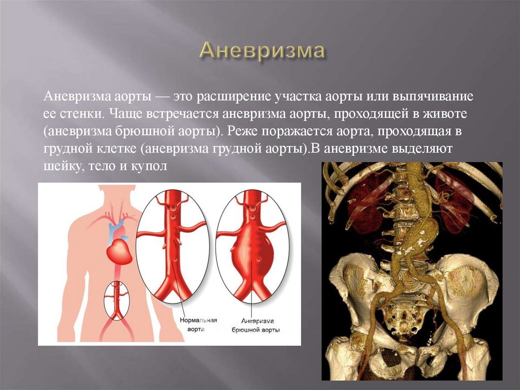 Симптомы аневризмы. Аневризма стенки аорты.