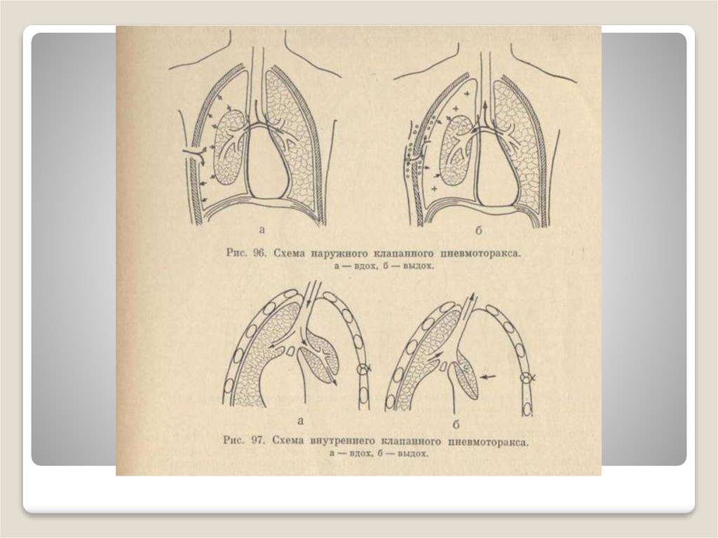 Клапанный пневмоторакс презентация