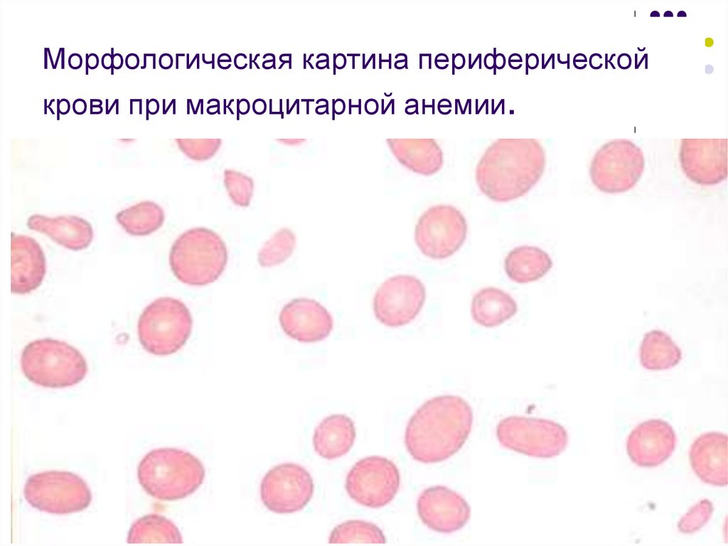 Пойкилоцитоз анемия