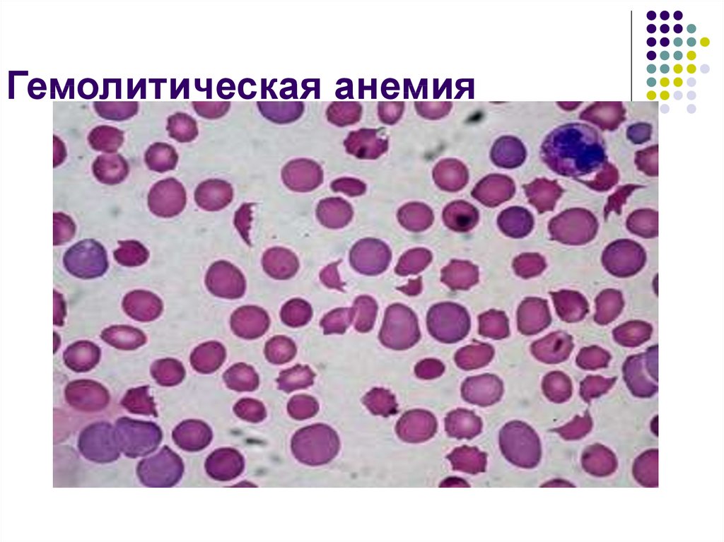 Анемия гемолитического типа. Аутоиммунная гемолитическая анемия картина крови. Гемолитическая анемия миелограмма. Гемолитическая анемия под микроскопом. Гемолитическая анемия у животных.