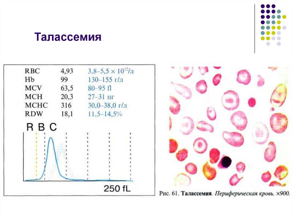 Талассемия что это. Талассемия бета талассемия. Классификация бета талассемия.