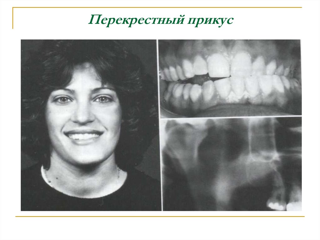 Перекрестный прикус схема лечения у взрослого