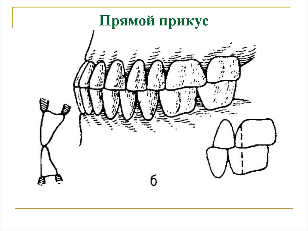 Прямой прикус картинка