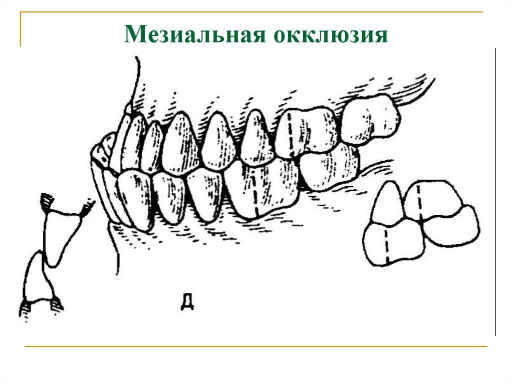 Мезиальная окклюзия презентация ортодонтия