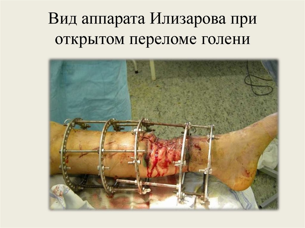 Вид аппарата Илизарова при открытом переломе голени