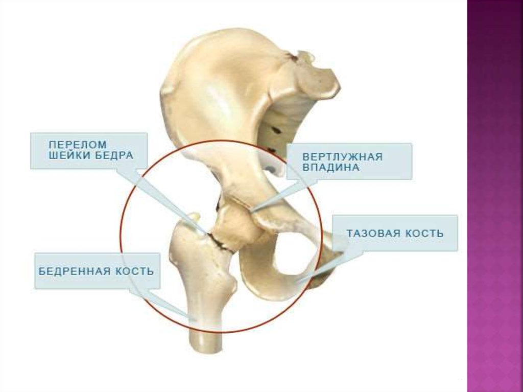 Симптомы шейки бедра как определить. Анатомия вертлужной впадины тазобедренного сустава. Тазобедренный сустав перелом шейки бедра. Таз вертлужная впадина перелом. Перелом тазобедренного сустава шейка бедра.