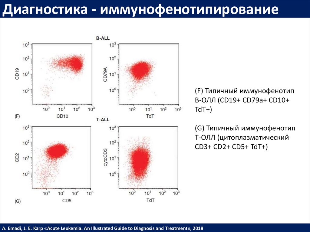 Острый лимфобластный лейкоз презентация