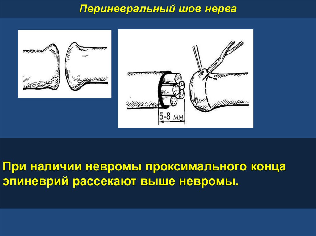 Шов нерва презентация