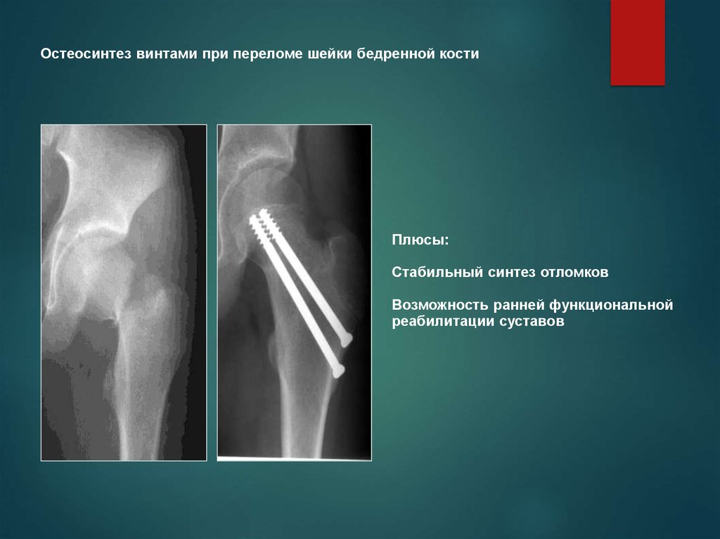 Операция остеосинтез. Костная мозоль после перелома шейки бедра. ИМПЛАСТ остеосинтеза бедренной кости. Тен при переломе костей. Остеосинтез бедренной кости отзывы пациентов.