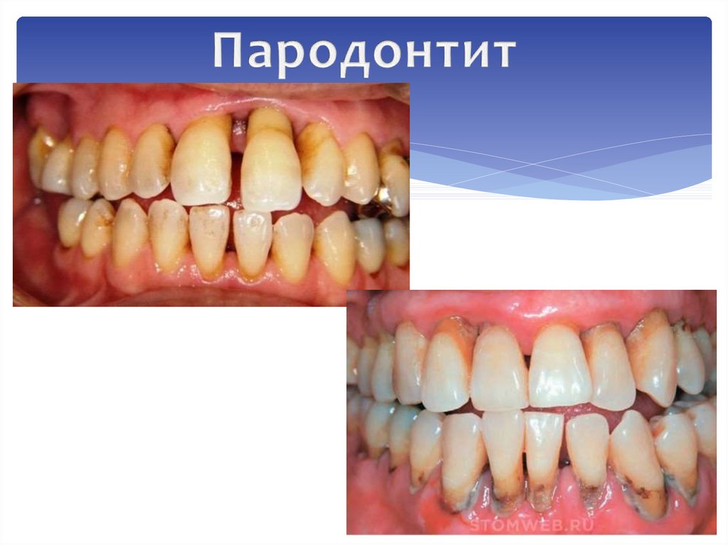 Пародонтит