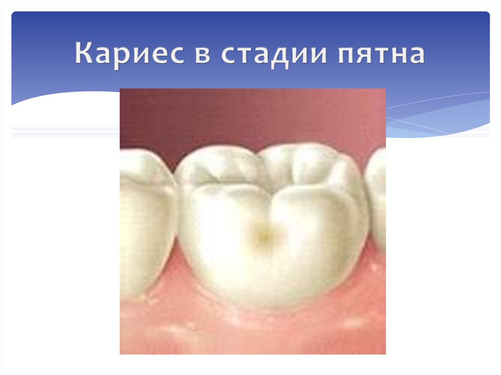 Кариес в стадии пятна