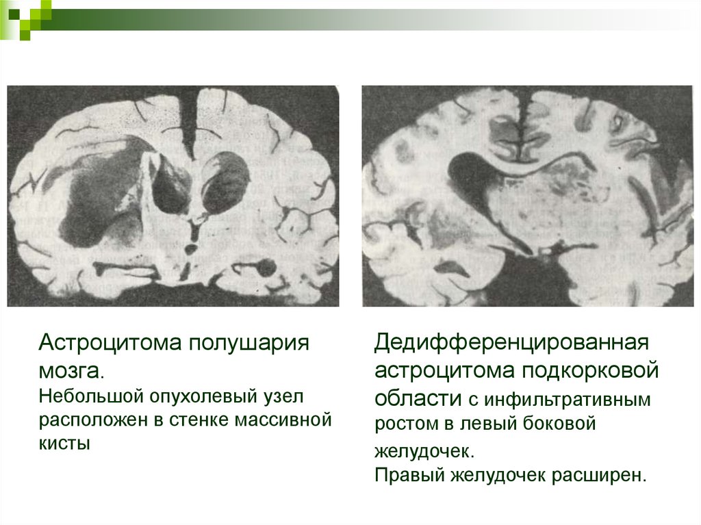 Астроцитома головного мозга прогноз. Фибриллярная астроцитома патанатомия. Астроцитома головного мозга дедифференцированная. Астроцитома головного мозга микропрепарат.