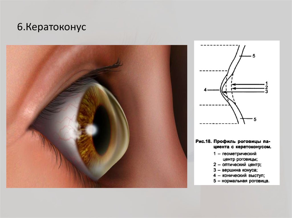 Презентация на тему кератоконус