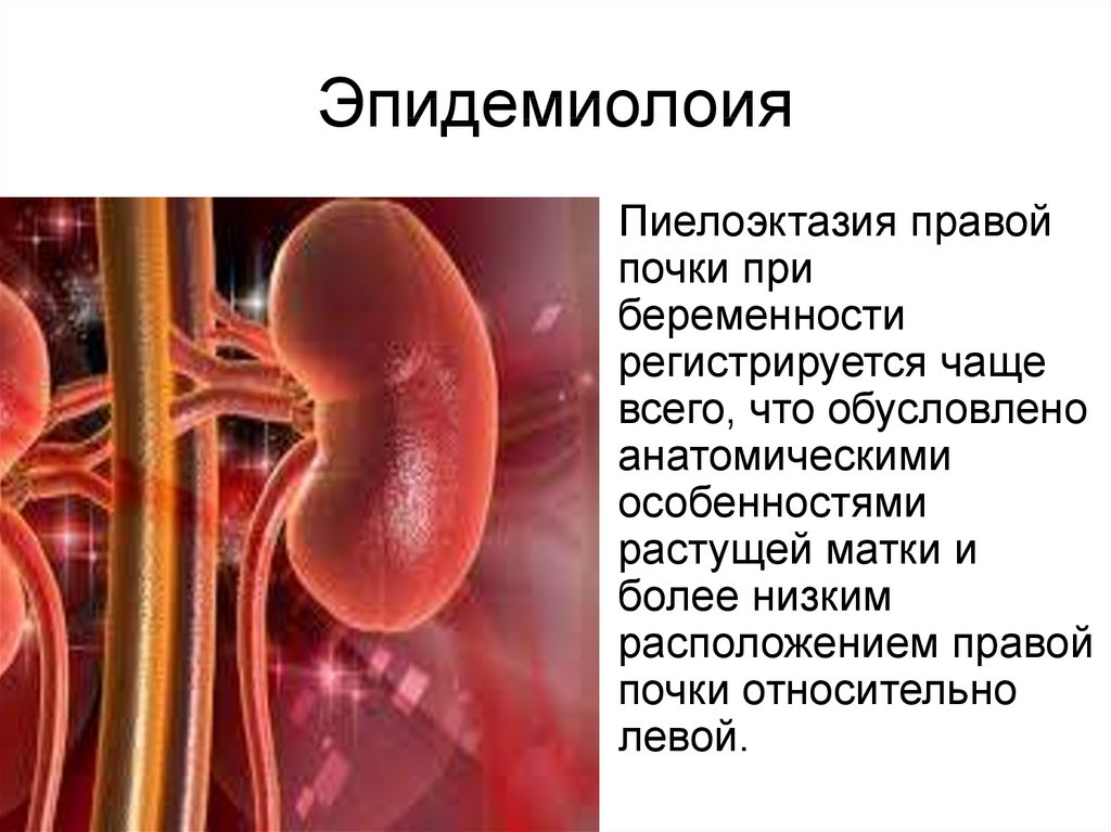 Гестационная пиелоэктазия - презентация онлайн