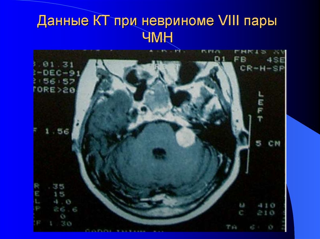 Viii черепного нерва. Невринома 8 пары ЧМН. Шваннома слухового нерва мрт. Невринома преддверно-улиткового (VIII) нерва.