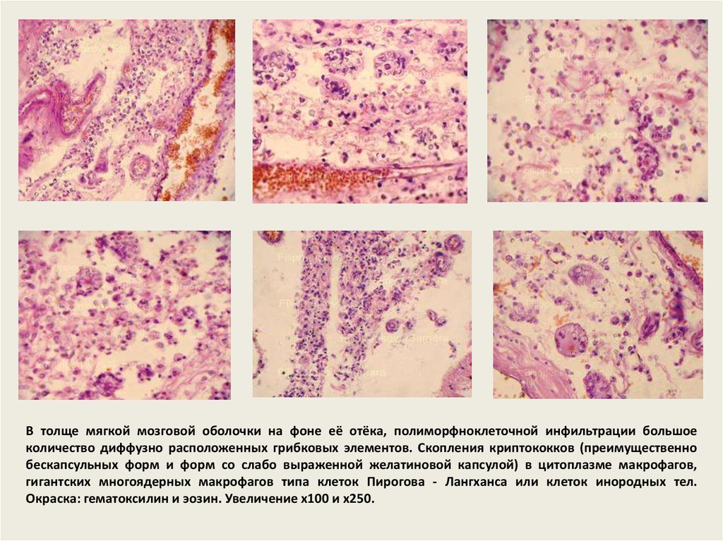 Фрагменты децидуальной ткани. Грибовидный микоз гистология. Инфильтрация гистология. Мягкая мозговая оболочка гистология. Полиморфноклеточная инфильтрация.