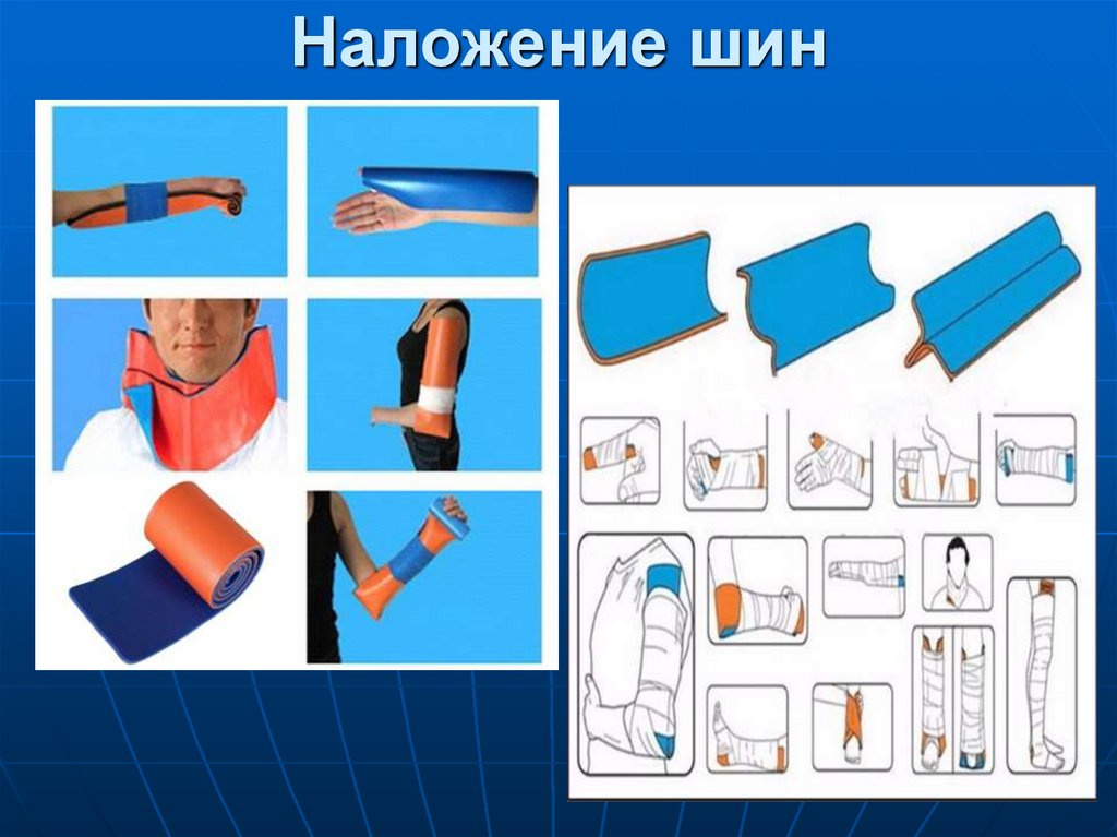 Наложение шин