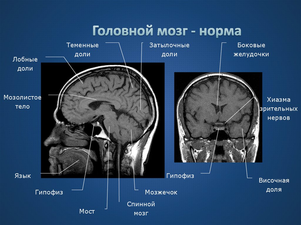Мрт головного мозга фото в норме
