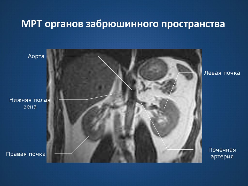 МРТ органов забрюшинного пространства