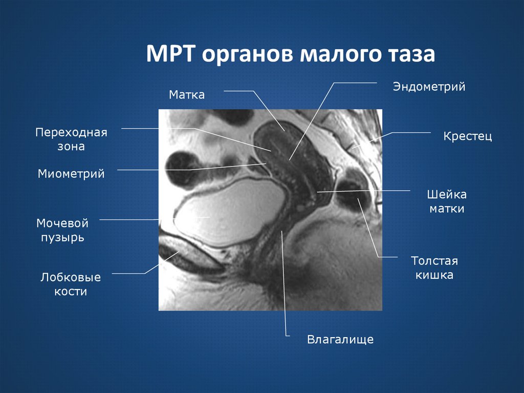 Мрт малого таза картинки