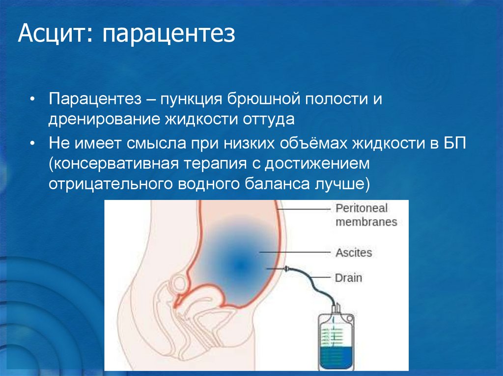 Асцит лечение у мужчин. Жидкость из брюшной полости. Жидкость в брюшной полости (асцит). Асцит это скопление жидкости в.