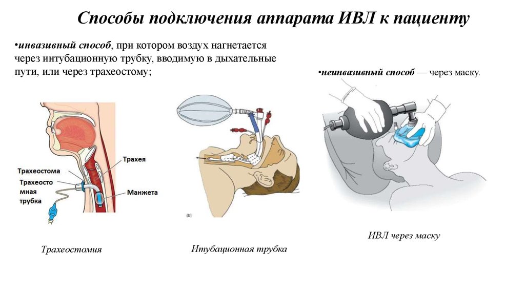 Интубация трахеи презентация