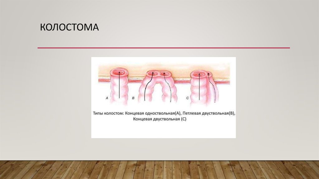 Колостома двуствольная схема