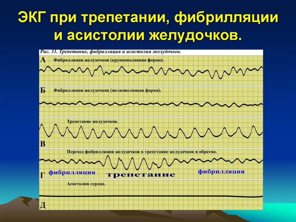 Асистолия на экг фото