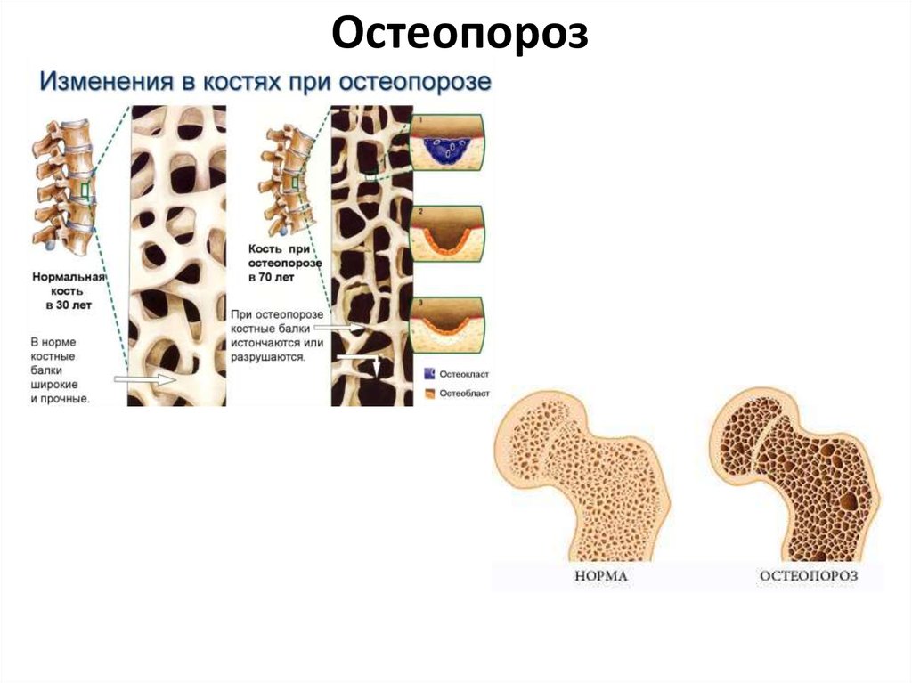 Структурные изменения костей. Остеопороз губчатого вещества. Нормальная кость и остеопороз. Остеопороз костей позвоночника. Заболевание костей остеопороз.