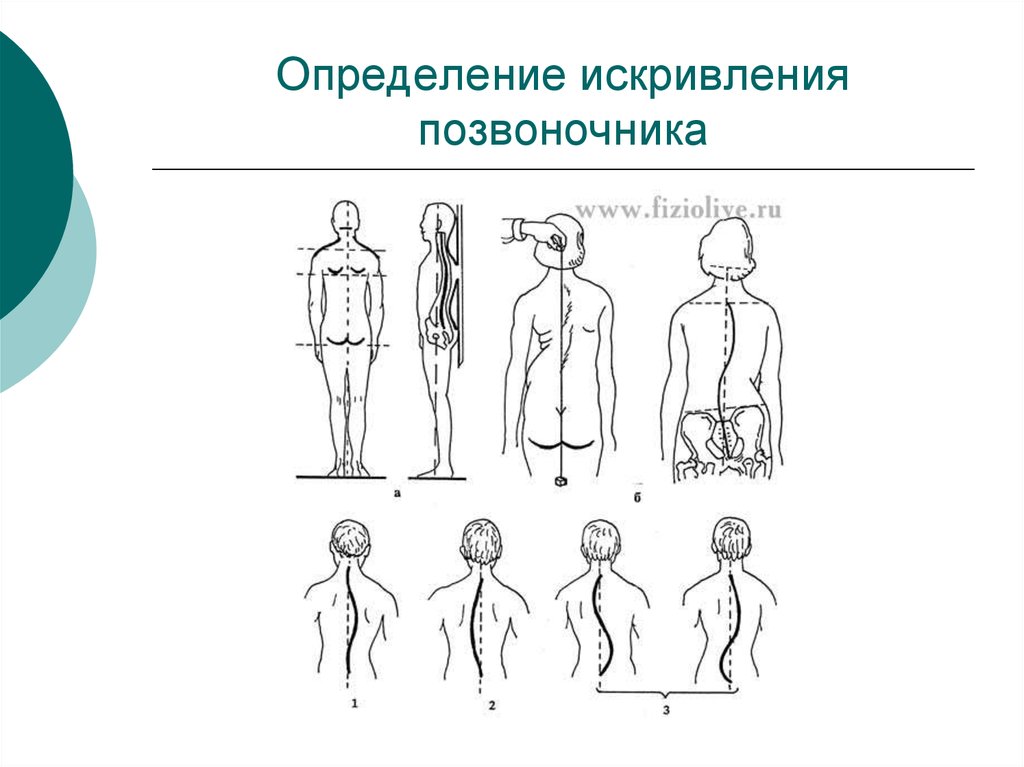 Все виды искривления позвоночника с картинками