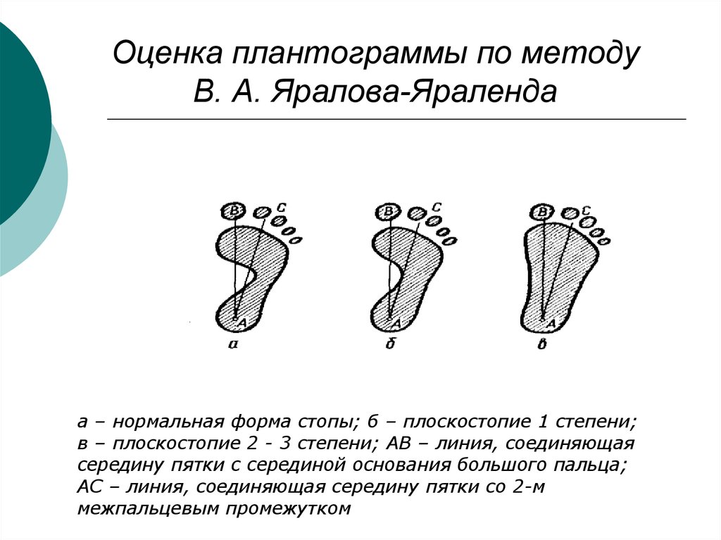 Положение стоп. Метод Яралова Яраленда. Оценка плантограммы по методу в.а. Яралова-Яраленда. Плантограмма Чижина. Плоскостопие степени плантограмма.