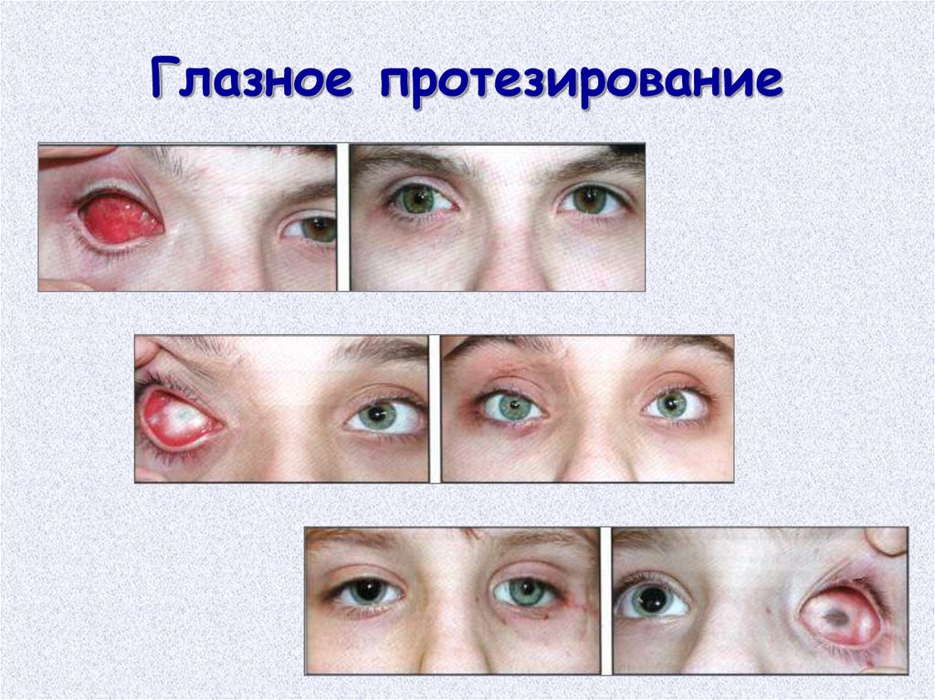 Глазная стой. Современные глазные протезы. Глазной протез офтальмология.