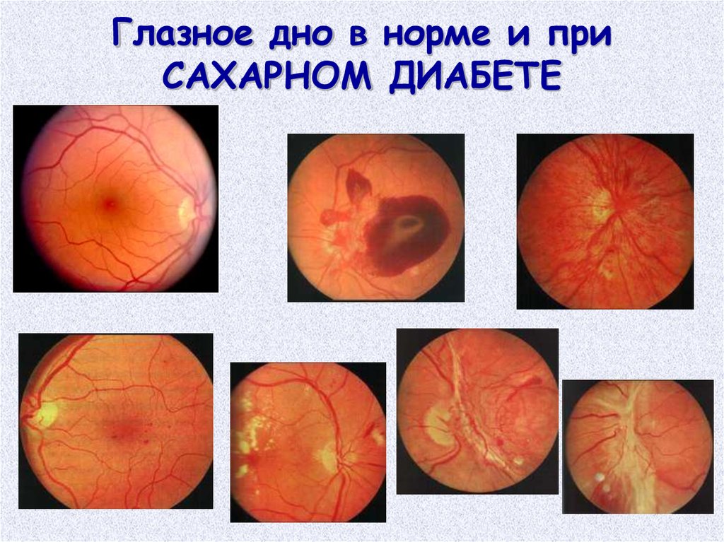 Диагноз глаз. Осмотр глазного дна норма. Псевдотуберкулез глазное дно. Как проверяют глазное Део. Глазное дно как проверяют.