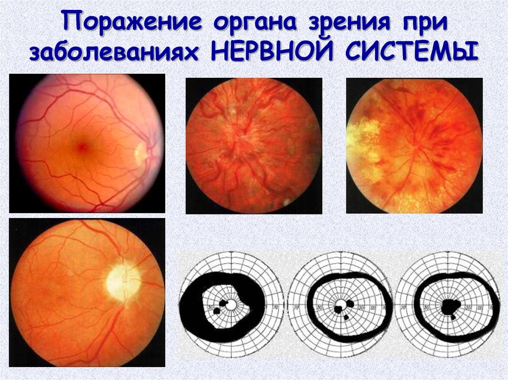 Поражение зрительного. Частичная атрофия зрительного нерва поля зрения. Поля зрения при атрофии зрительного нерва. Поражение органов зрения. Зрение при атрофии зрительного нерва.