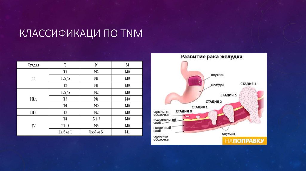 Онкология желудка 4 стадия. Опухоли желудка классификация. Опухоль желудка стадии. Стадии TNM. Опухоль желудка по ТНМ.