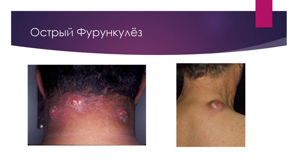 Фурункулёз. Виды, причины, возбудитель фурункулёза. Диагностика ...