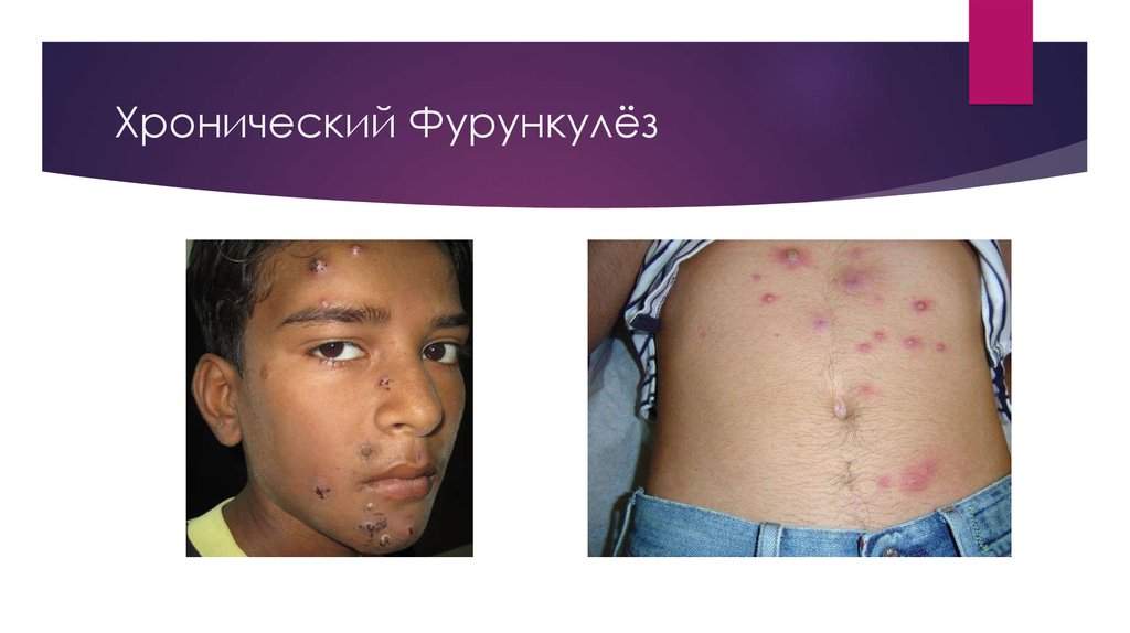 Хронический Фурункулёз