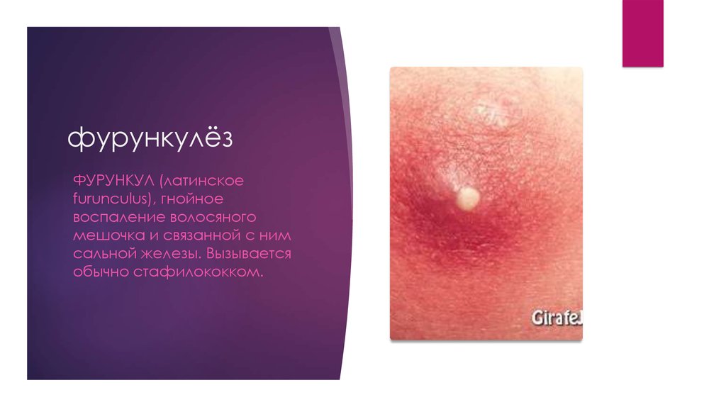 фурункулёз