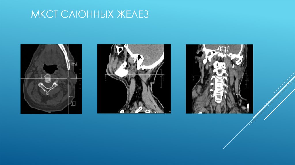 Лучевая диагностика заболеваний слюнных желез презентация