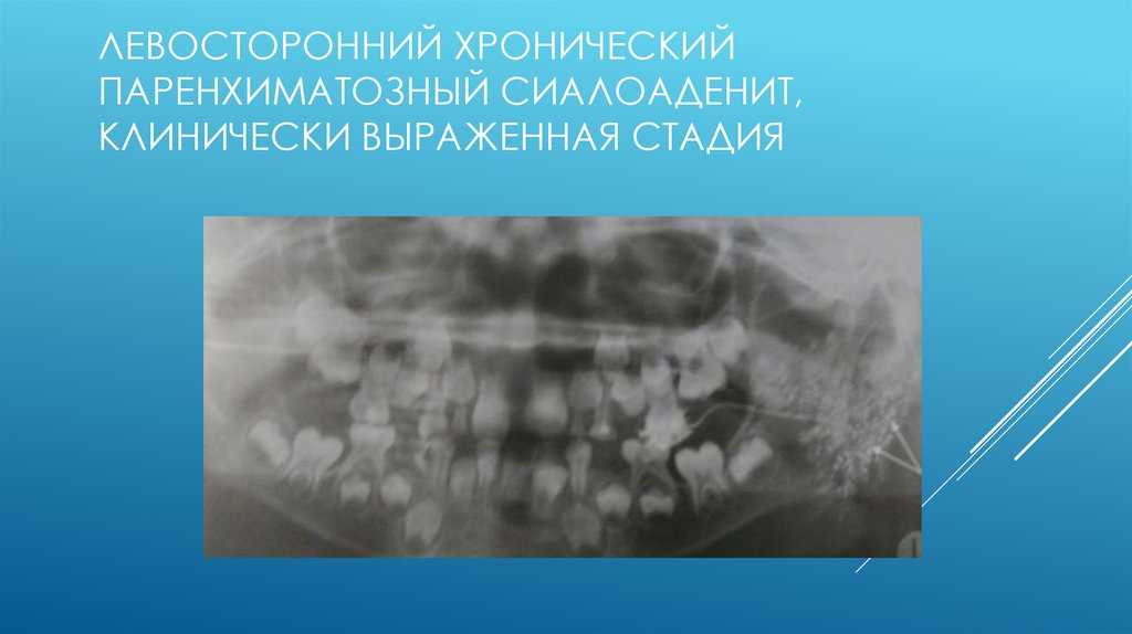 Хронический паренхиматозный паротит у детей презентация