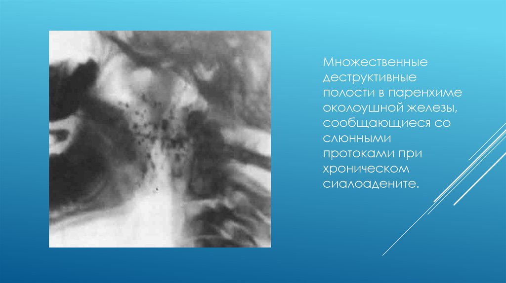 Паренхима слюнной железы. Рентгенодиагностика слюнных желез. Лучевая диагностика воспалительных заболеваний слюнных желез. Обзорная рентгенография слюнных желез. Воспаление протоков слюнных желез.