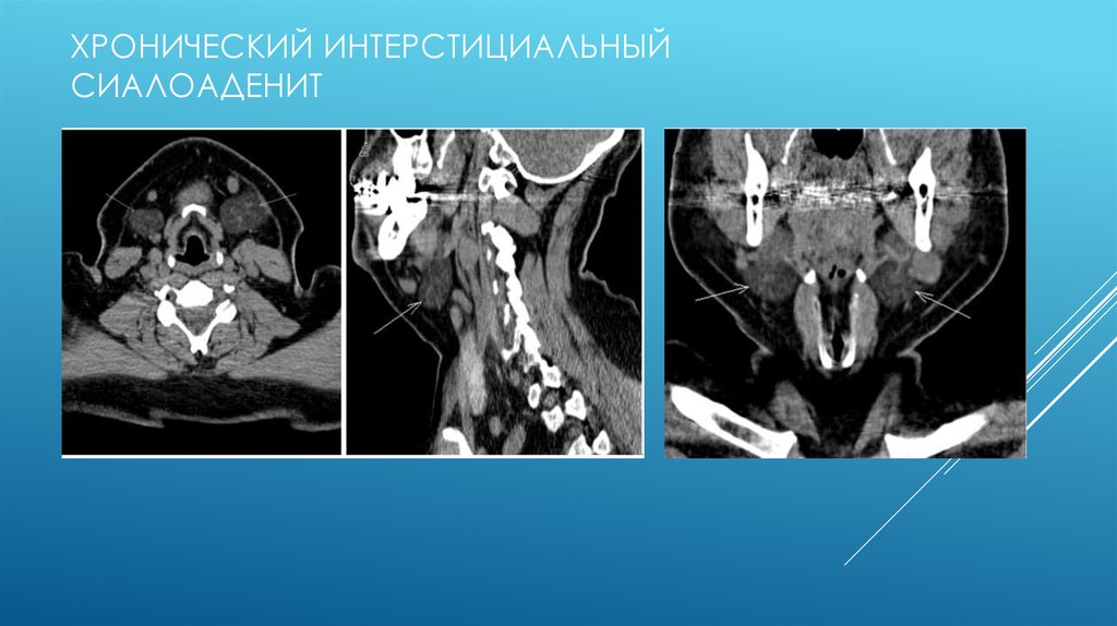 Лучевая терапия при раке слюнных желез