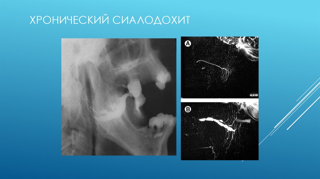 Сиалография слюнных