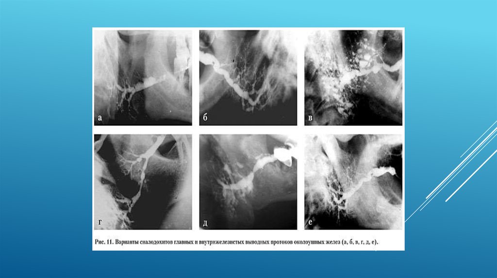 Лучевая железа. Сиалодохит рентгенодиагностика. Хронический сиалодохит. Туберкулез слюнных желез сиалография. Сиалограмма при хроническом сиалодохите.