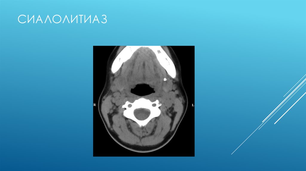 Лучевая диагностика заболеваний слюнных желез презентация