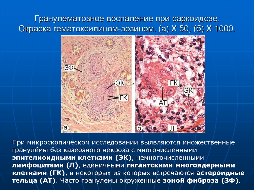 Саркоидная гранулема. Саркоидоз лимфатических узлов. Саркоидоз патологическая анатомия. Абсцедирующая гранулёма. Туберкулезной гранулемы патанатомия макропрепарат.
