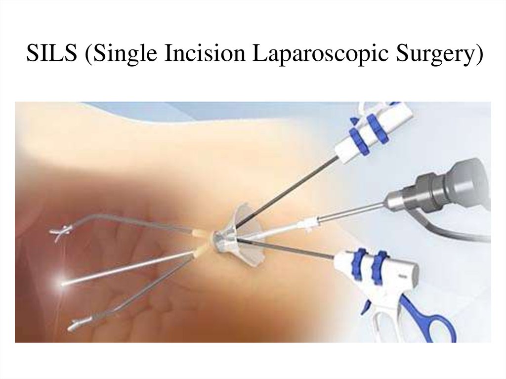 SILS (Single Incision Laparoscopic Surgery)
