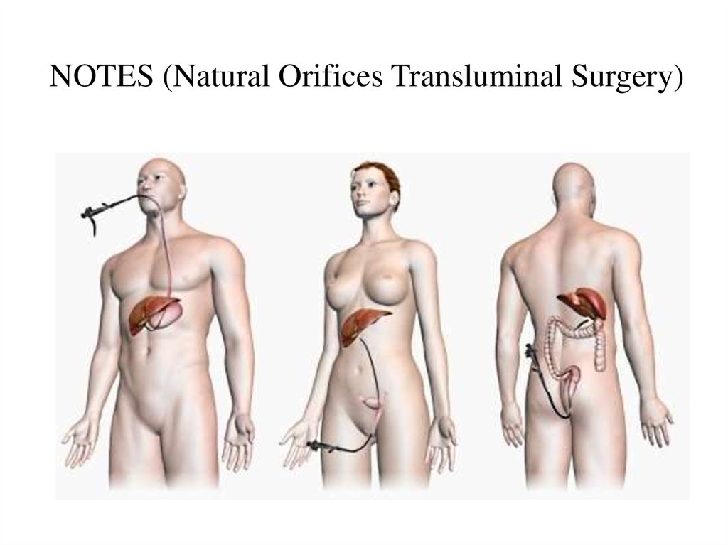 NOTES (Natural Orifices Transluminal Surgery)