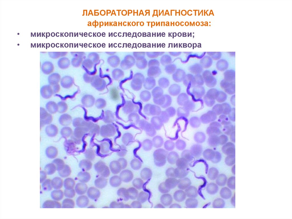 Болезнь лабораторная. Трипаносома Африканская и американская. Африканский трипаносомоз меры профилактики. Трипаносома диагностика. Лабораторная диагностика американского трипаносомоза.