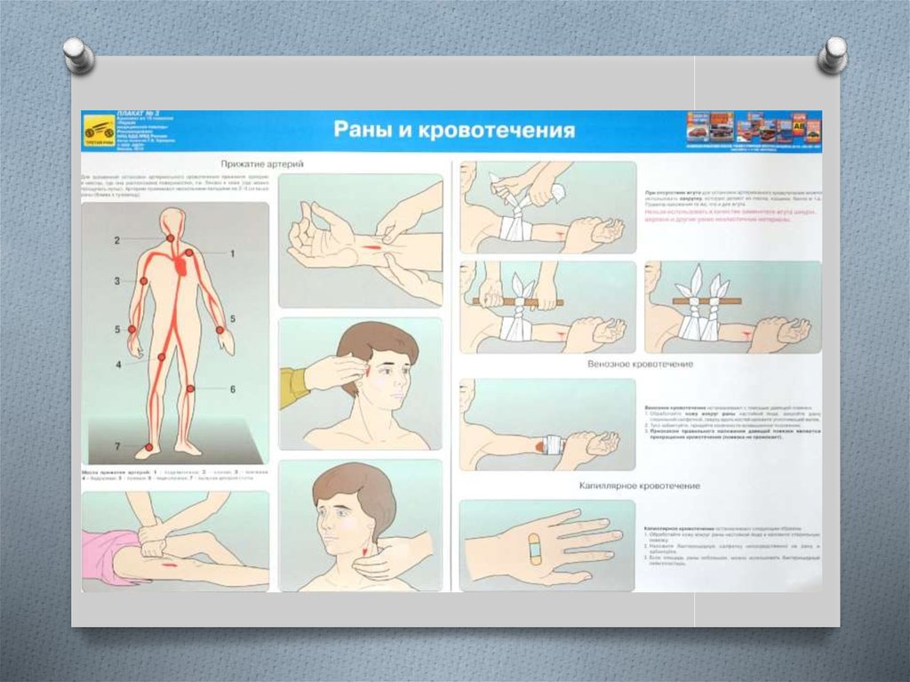 Оказание первой доврачебной помощи при кровотечении. Остановка кровотечения плакат. Кровотечение плакат. Остановка кровотечения первая медицинская помощь. Остановка кровотечений при ДТП.